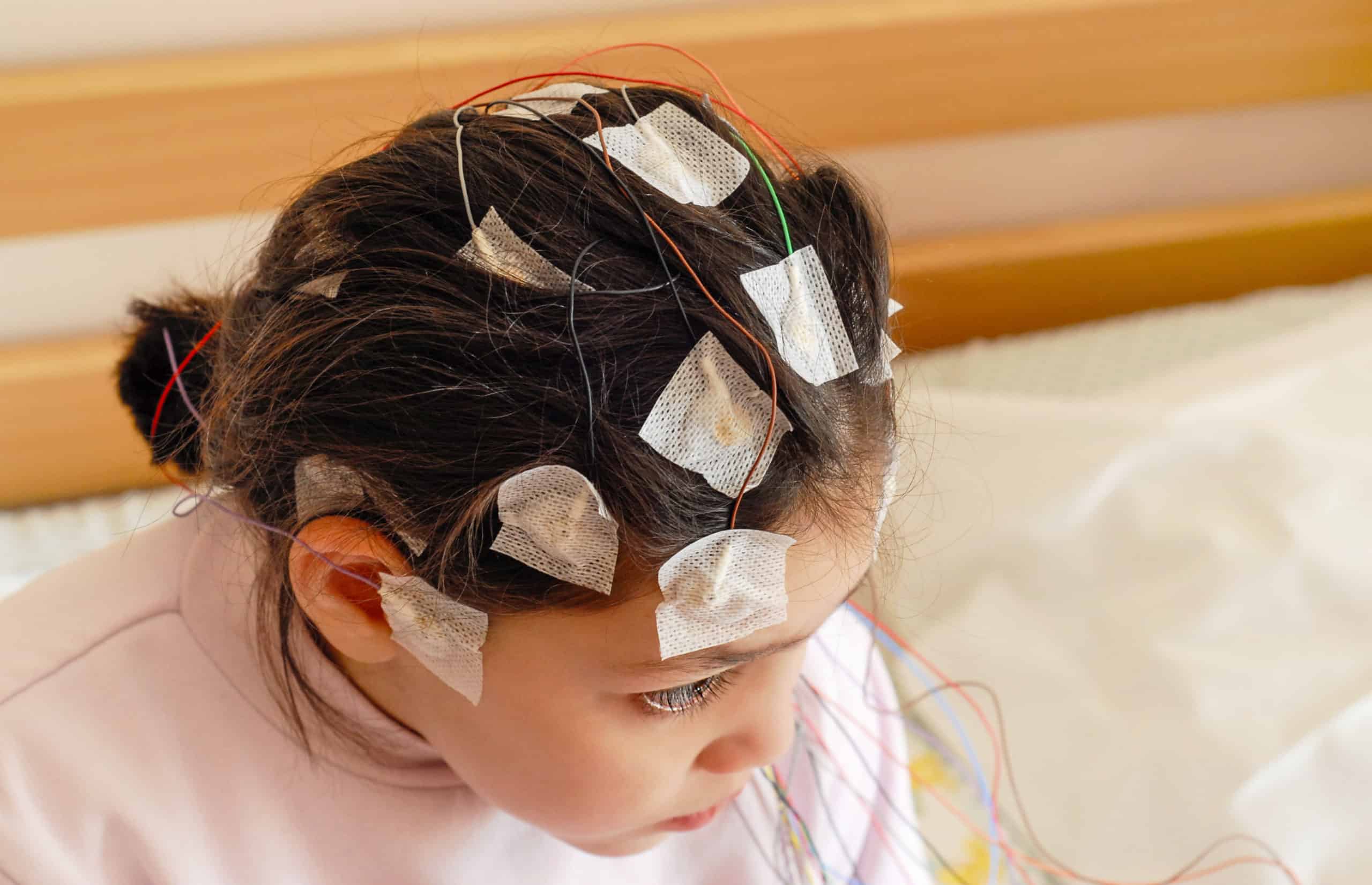 Girl with EEG electrodes attached to her head for medical test autism and seizures, autism seizure, autism and epilepsy, autism epilepsy