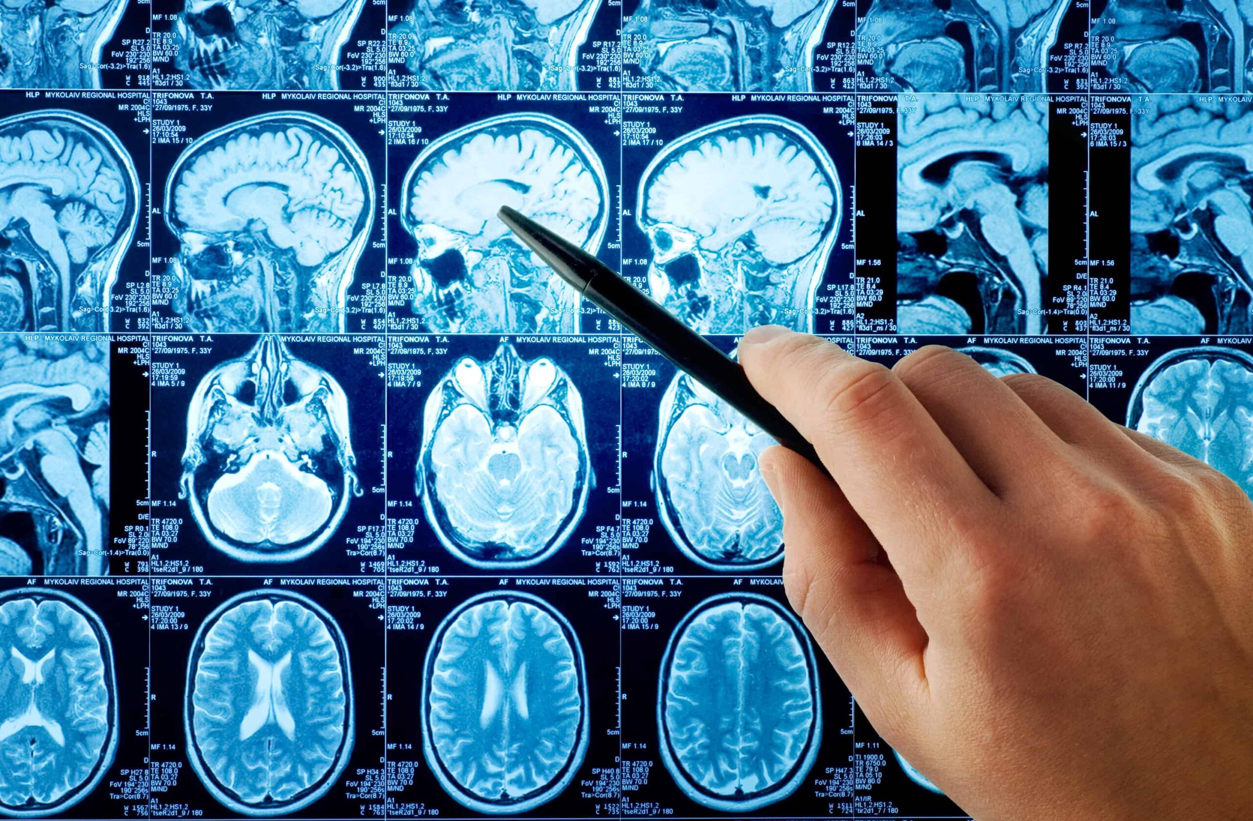 MRI,brain